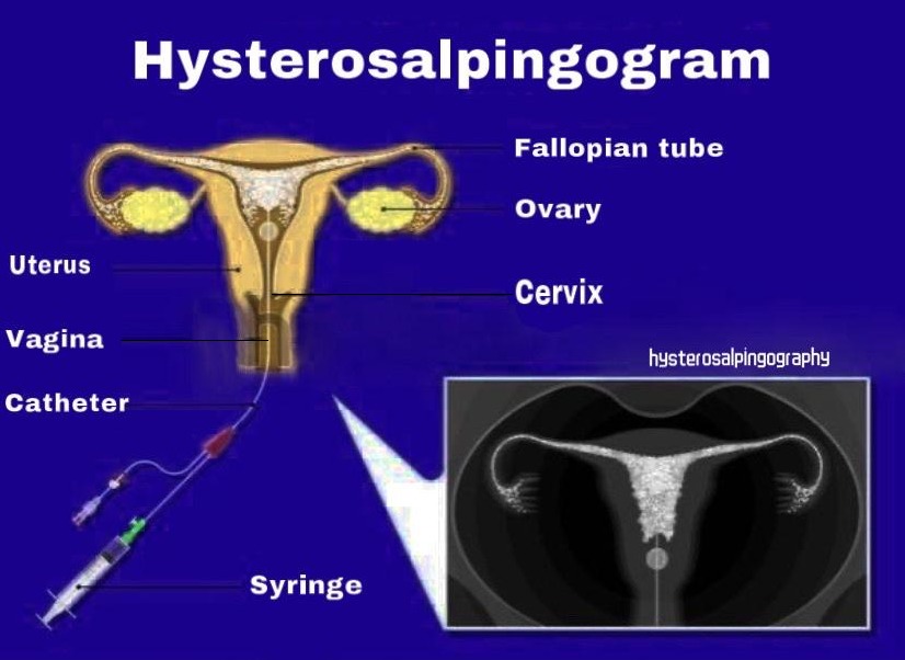 Hysterosalpingogram (HSG)